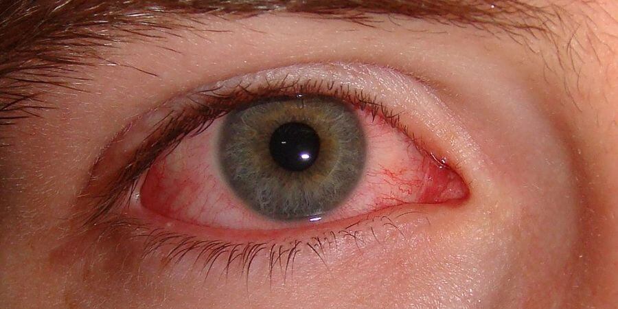 pink eye