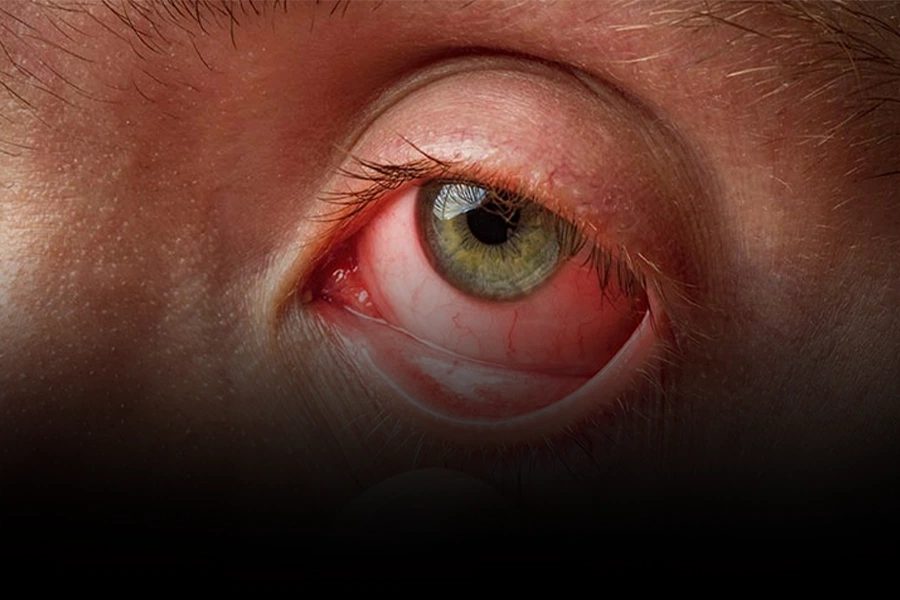 Conjunctivitis What Is Pink Eye