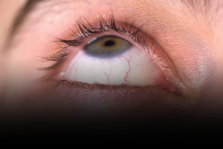 The Invisible Risk Inside Your Eyes Ocular Hypertension