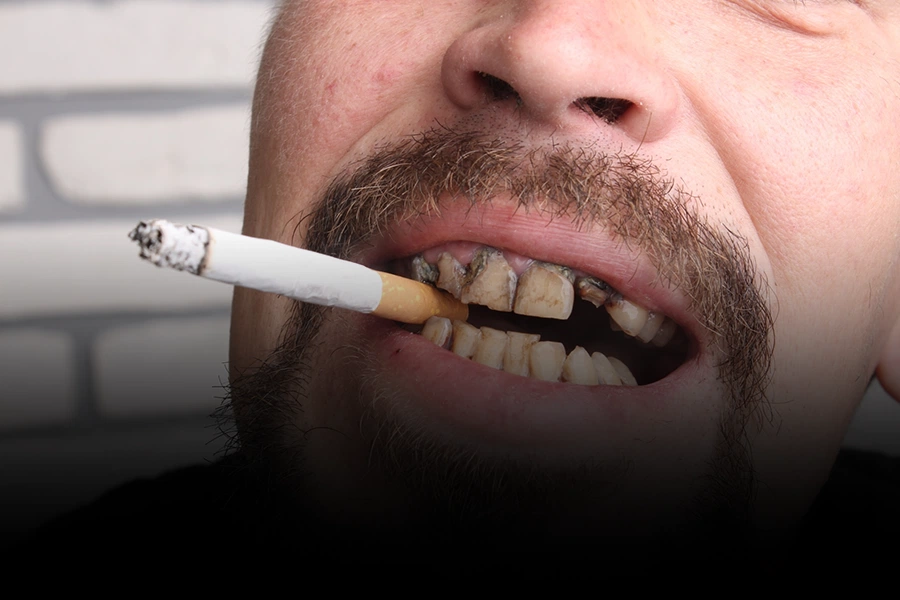 A man showing the effects of smoking with severely damaged and discolored teeth while holding a cigarette in his mouth