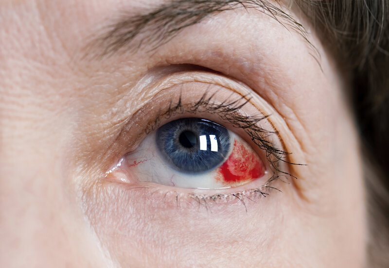 ocular-hypertension-a-precursor-to-glaucoma