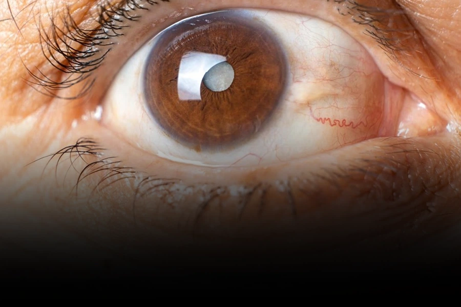 what does glaucoma look like