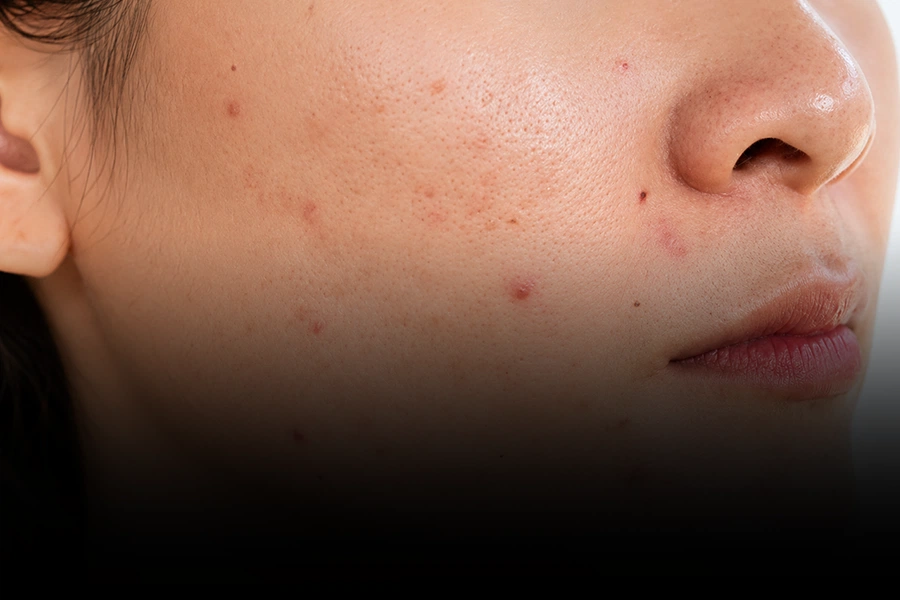 Oily skin with clogged pores and acne breakouts